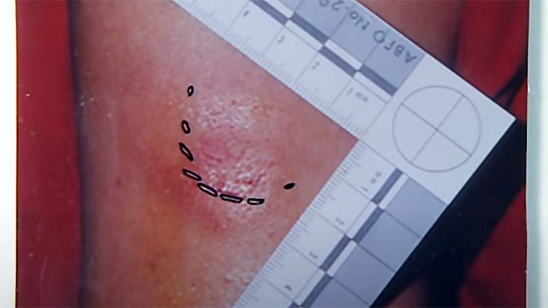 Helga Luest bite mark forensic photography