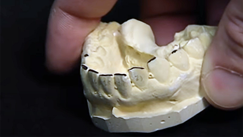 Stanley Cornet dental casting