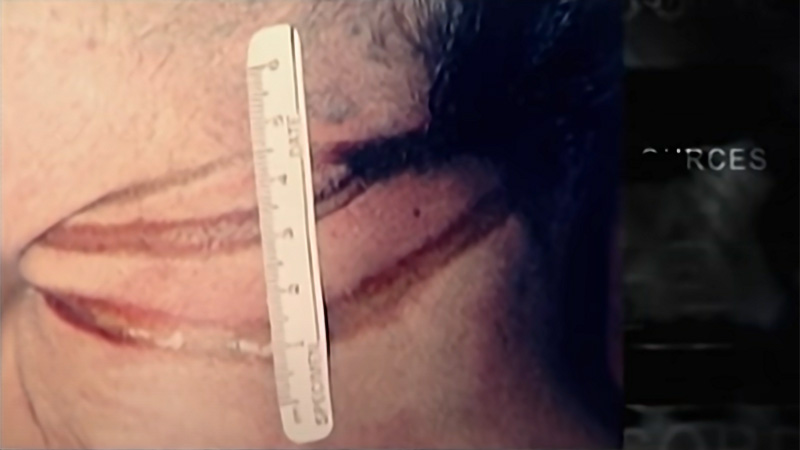 Ligature marks on Ellen Sherman's neck