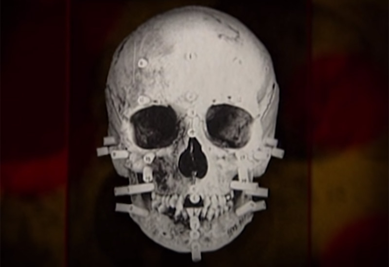 Skull with forensic depth markers