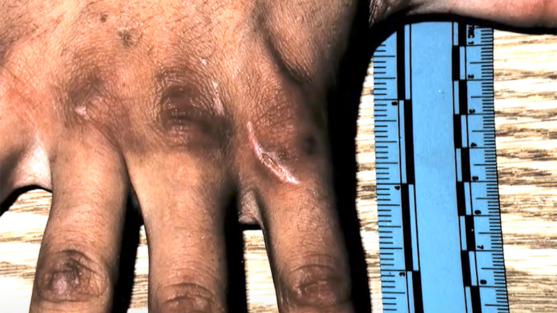 Healing cut on Jeremie Overstreet's hand