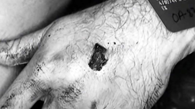 Bill's left hand with bullet wound